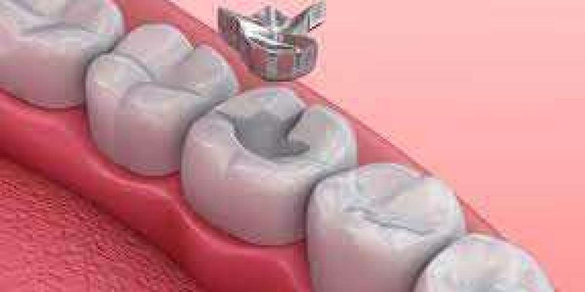 All You Need To Know About Amalgam Fillings